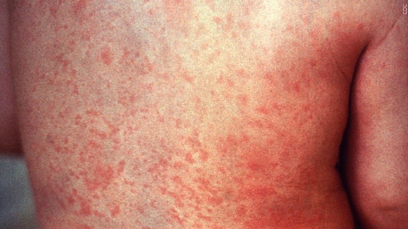 Measles cases are rising in the U.S., the CDC reports.